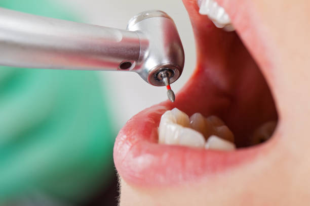 Best Knocked-Out Tooth Emergency  in , VT